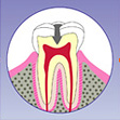 象牙質の虫歯
