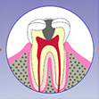 神経の虫歯